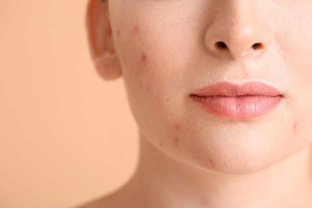 acne-infinitytreasureweb